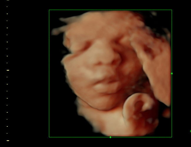 3D ultrasound image at 30 weeks